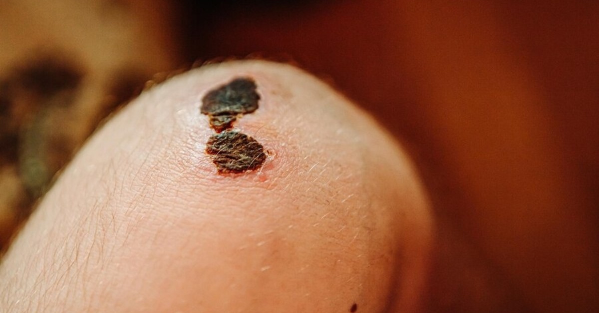 Black Fungus Treatment in Indore