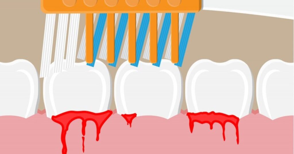 Bleeding Gums Treatment in Indore