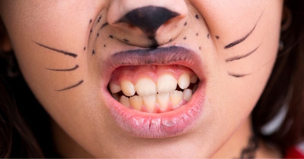 Bruxism treatment in Indore-