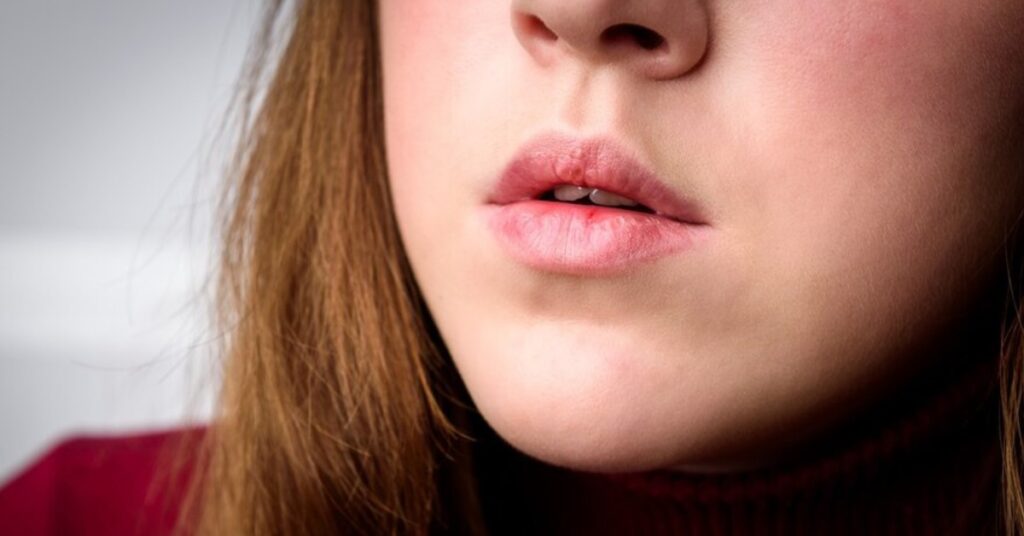 Chapped Lips Treatment in Indore