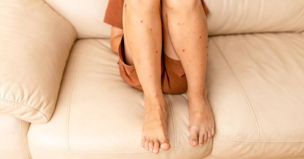 Dark Spots Legs treatment in Indore
