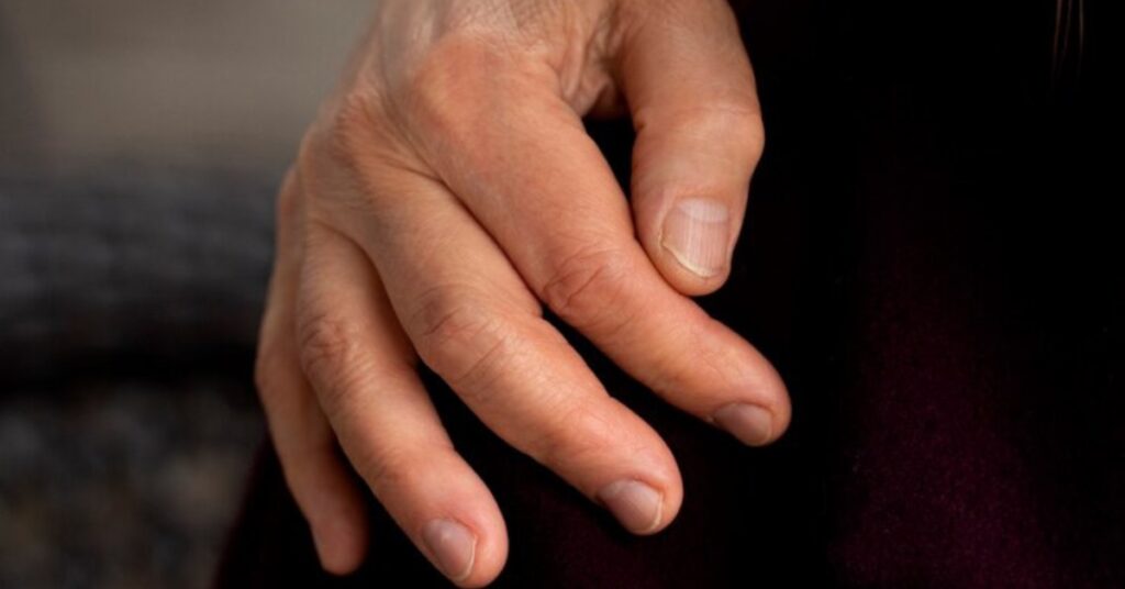 Dark Spots On Nails Treatment in Indore