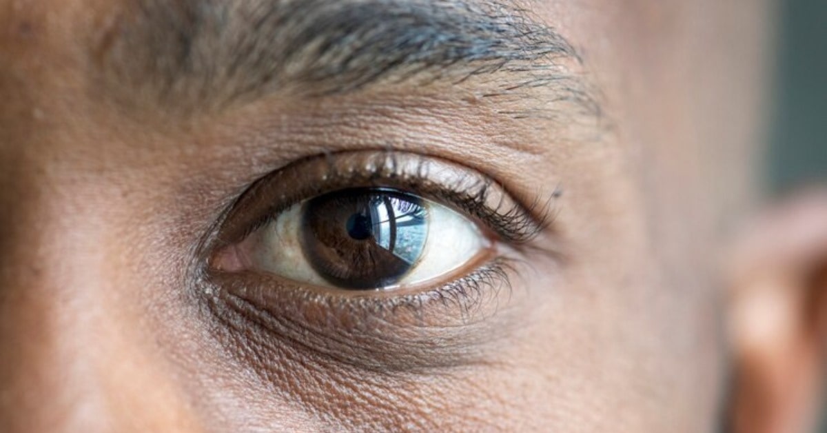 black eye treatment in Indore