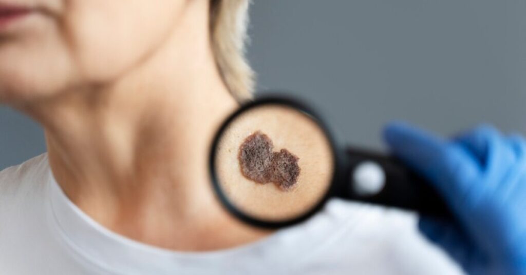 काली फफूंदी का उपचार इंदौर