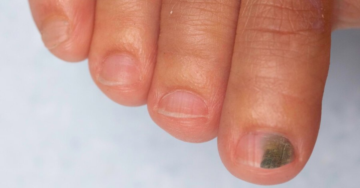 नाखूनों पर काले धब्बों का उपचार इंदौर में