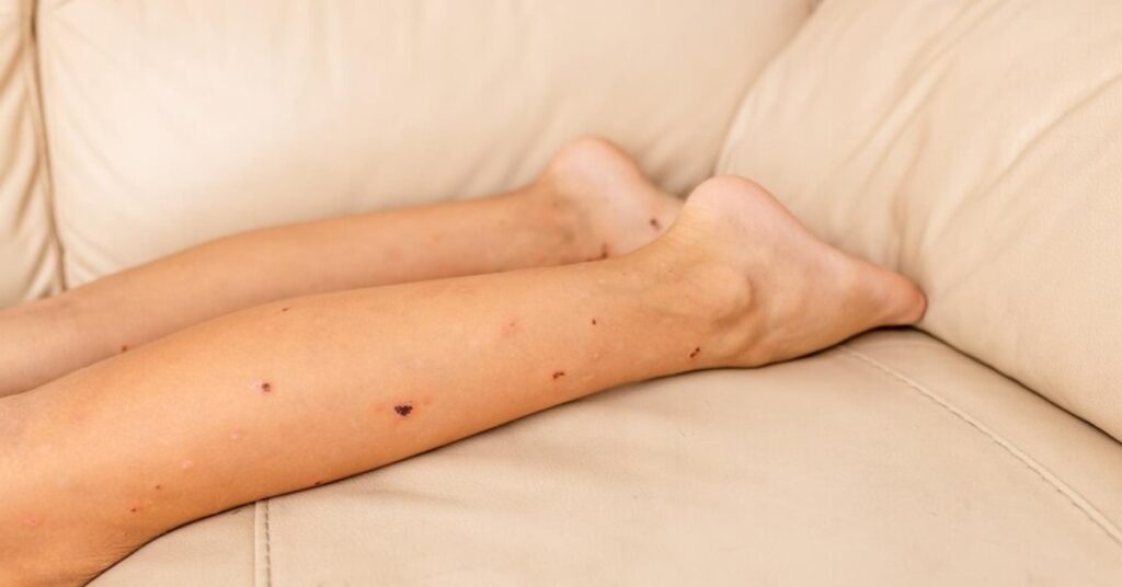 पैरों पर काले धब्बे उपचार का इंदौर