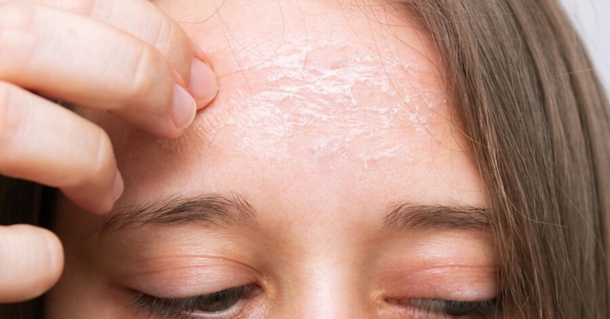 रूखी त्वचा