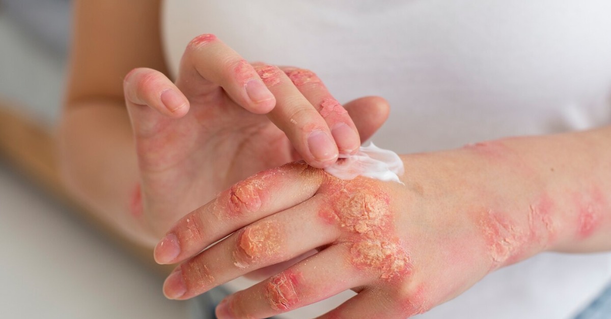 Psoriasis