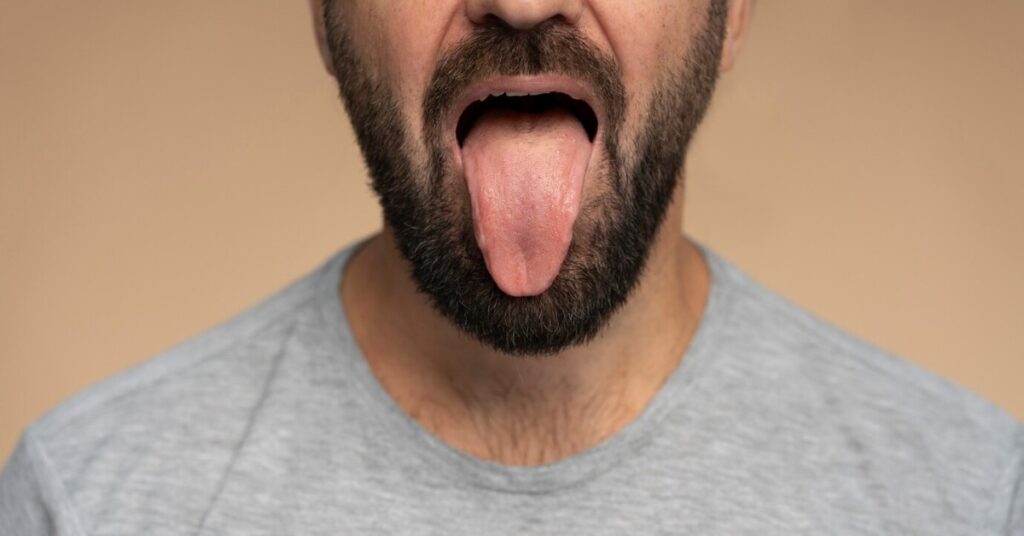 Tongue Sores