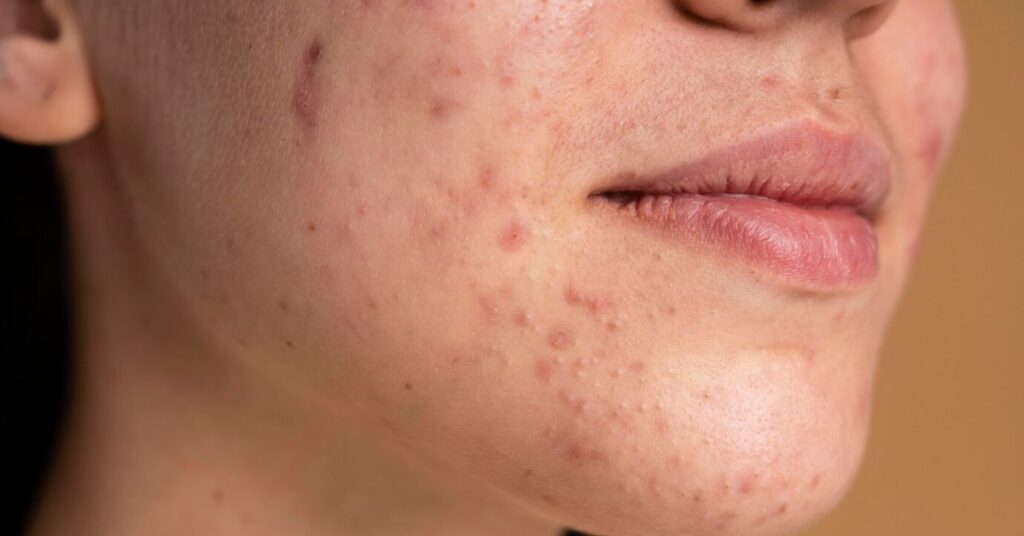 ओमेगा 3 की कमी के लक्षण