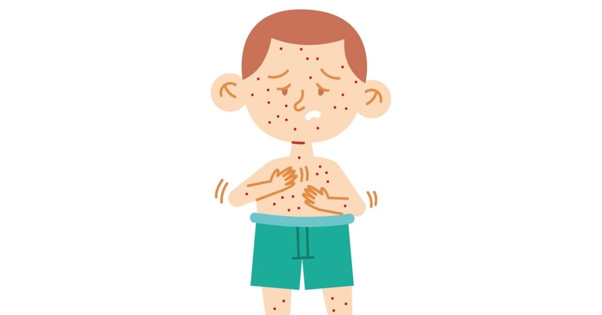 बच्चों में दाने